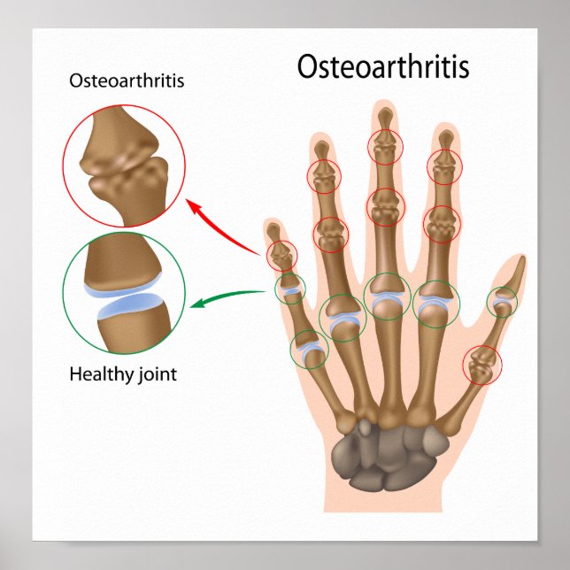 Osteoarthritis of the hand Poster (Devant)