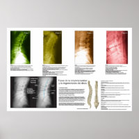 Phases Espagnoles Lumbar Affiche de dégénérescence