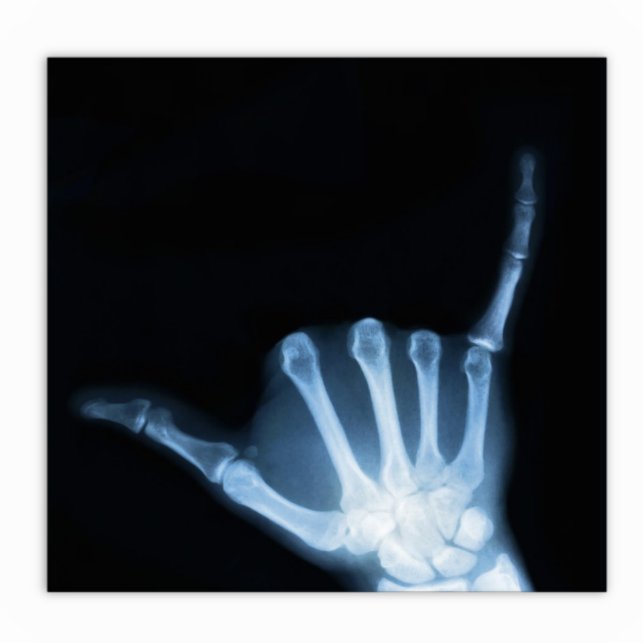 Photo Sculpture SYMBOLE Shaka X-Ray (Perdre la main) (Devant)