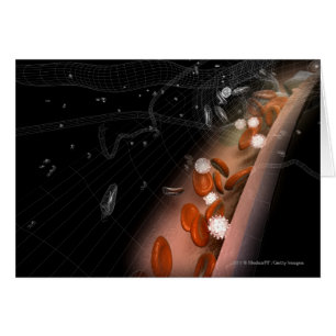 Plaque dans les artères