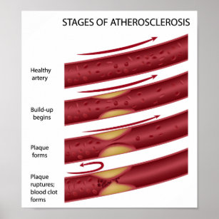 Plaques de cholestérol Poster