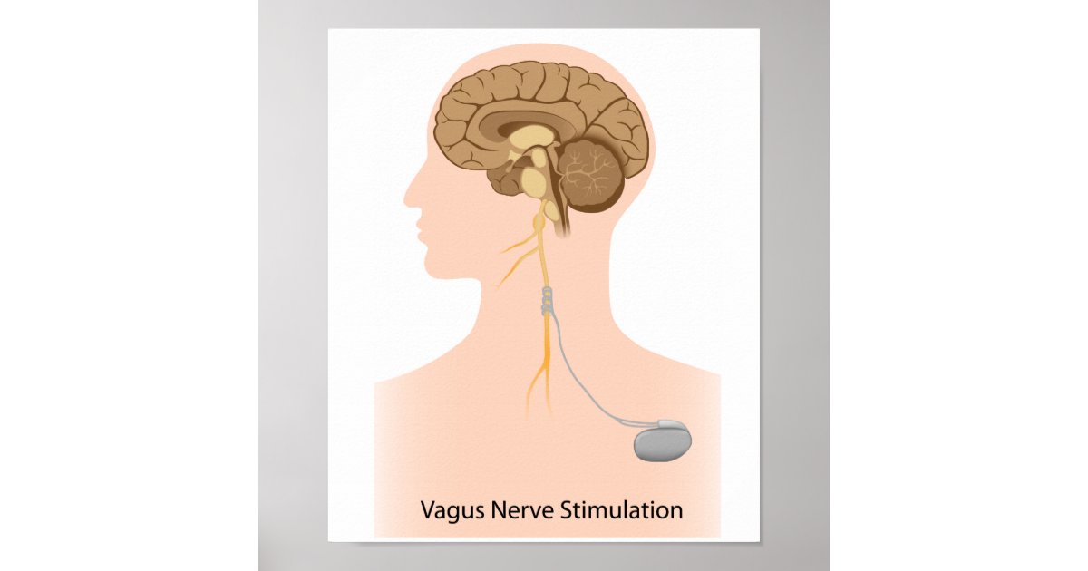 Poster Affiche de thérapie de stimulation de nerf vague Zazzle.fr