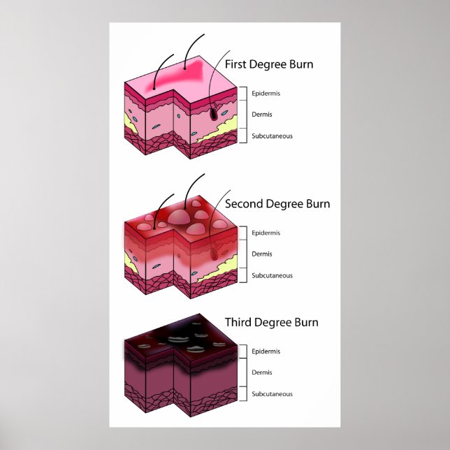 Poster Brûleur de peau premier Diagramme de deuxième et t (Devant)