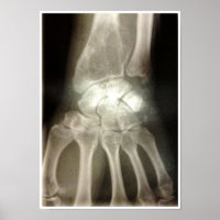 Poster Carpals Xray