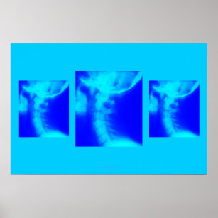 Poster chiropratique : Blues cervicales latéraux