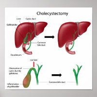 Cholecystectomie vésicule biliaire enlèvement chir