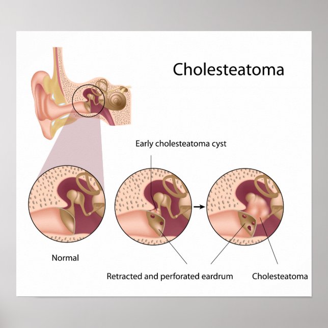 Poster Cholesteatoma tumeur de l'oreille moyenne (Devant)