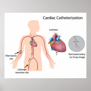 Poster de cathétérisation cardiaque
