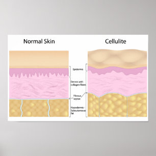 Poster de cellulite