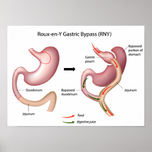 Poster de chirurgie de dérivation gastrique Roux-e