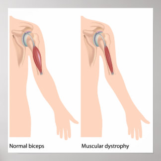 Poster de la dystrophie musculaire