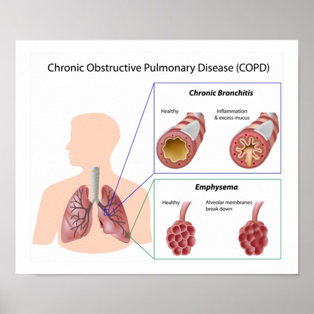 Poster de la maladie pulmonaire (MPOC) (Devant)