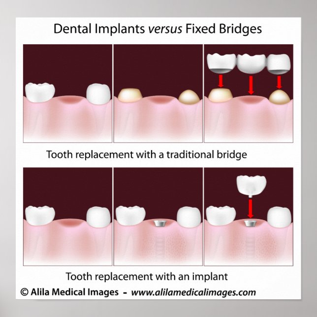 Poster de l'implant dentaire contre le pont (Devant)