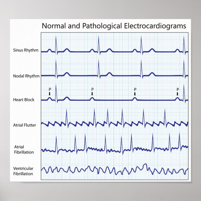 Poster d'ecg normal et pathologique (Devant)