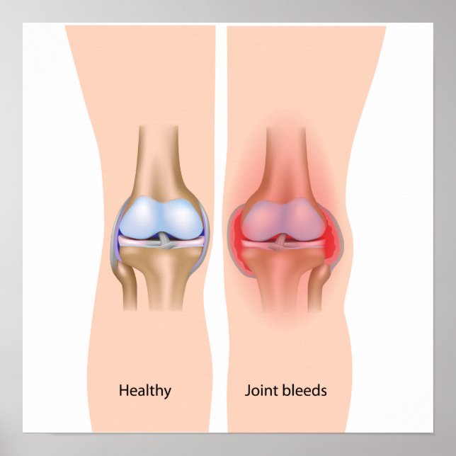 Poster des saignements communs en hémophilie (Devant)
