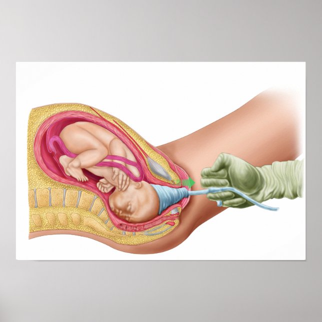 Poster Illustration Montrant La Livraison Du Foetus 1 (Devant)