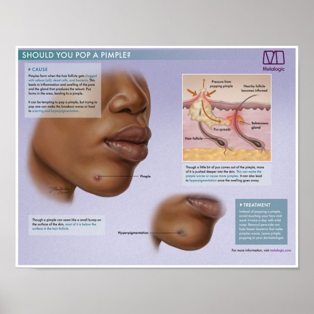 Poster Médicale de boutons de Popping Melalogique (Devant)