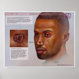Poster Médicale de Carcinome de la cellule de base