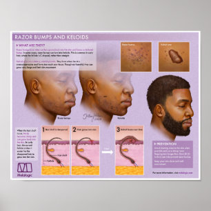 Poster Médicale de Razor Melalogique et Keloïdes