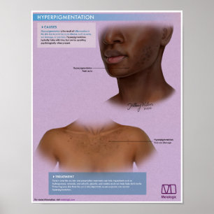 Poster Médicale d'Hyperpigmentation Melalogique