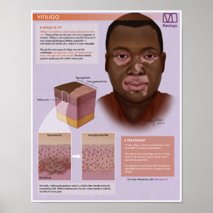 Poster Médicale Melalogo Vitiligo