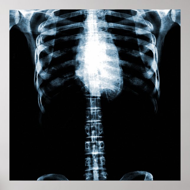 POSTER SKELETON X-RAY TORSO RIBS - BLEU (Devant)