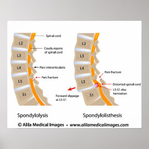 Poster Spondylolyse et spondylolisthèse, étiquetés