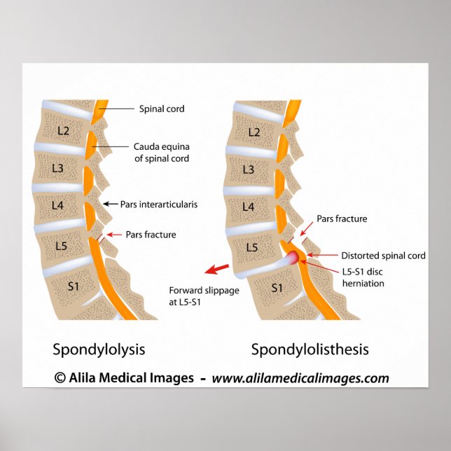 Poster Spondylolyse et spondylolisthèse, étiquetés (Devant)