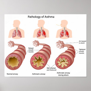 Poster sur la maladie pulmonaire Asthma