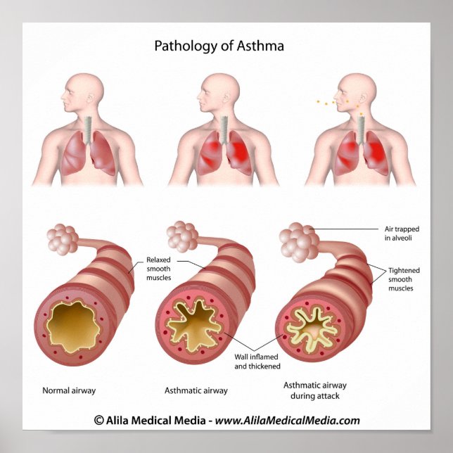 Poster sur la maladie pulmonaire Asthma (Devant)