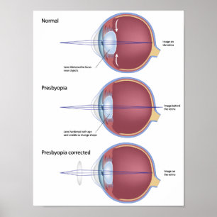 Poster sur la presbyopie des yeux