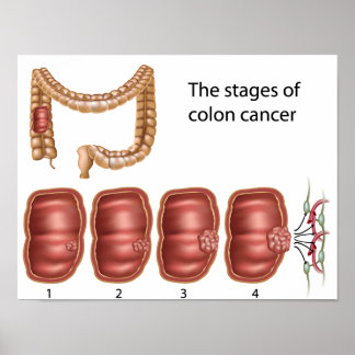 Poster sur la progression du cancer du côlon