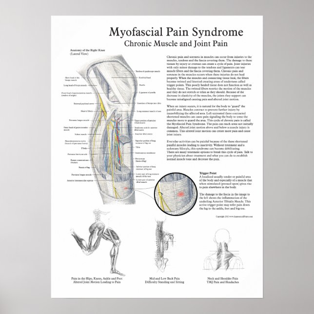 Poster sur le syndrome de douleur myofascial (Devant)