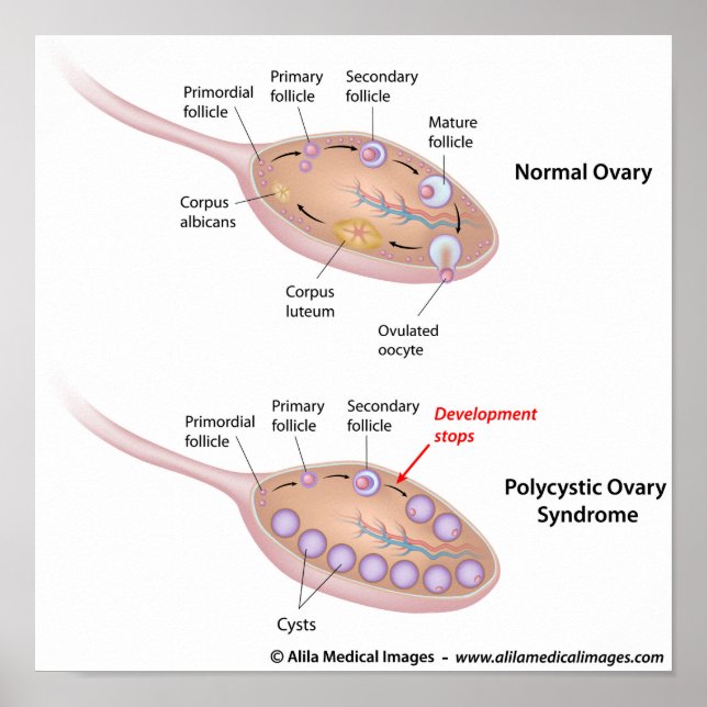 Poster Syndrome de l'ovaire polykystique, diagramme étiqu (Devant)
