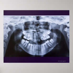 Poster Xray d'une mâchoire fillette prise avec le panoram