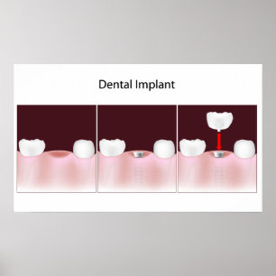 Procédure d'implant dentaire Poster
