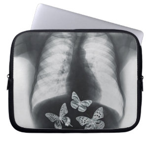 Protection Pour Ordinateur Portable Rayon X des papillons dans l'estomac