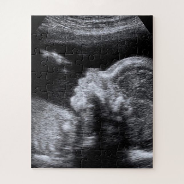 Puzzle Photo Ultrasound (Vertical)