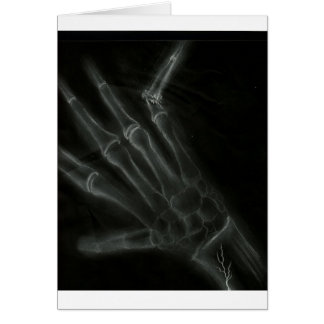 Rayon X cassé de main