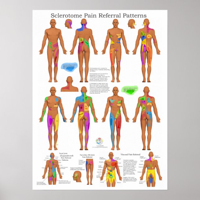 Sclérotome Douleur articulaire Poster Chiropratiqu (Devant)