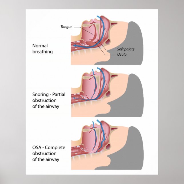 Snoring and sleep apnea Poster (Devant)