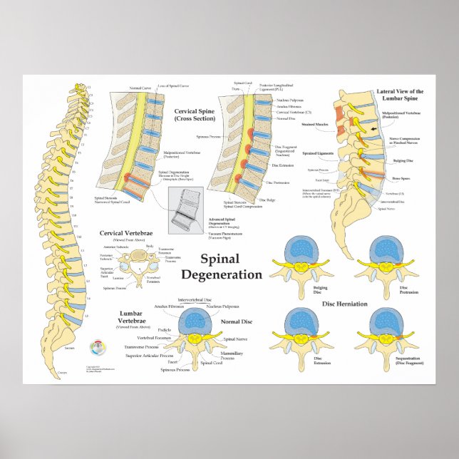 Spinal Degeneration Disc Herniation Poster (Devant)