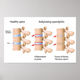 Spine Ankylose spondylitis Poster