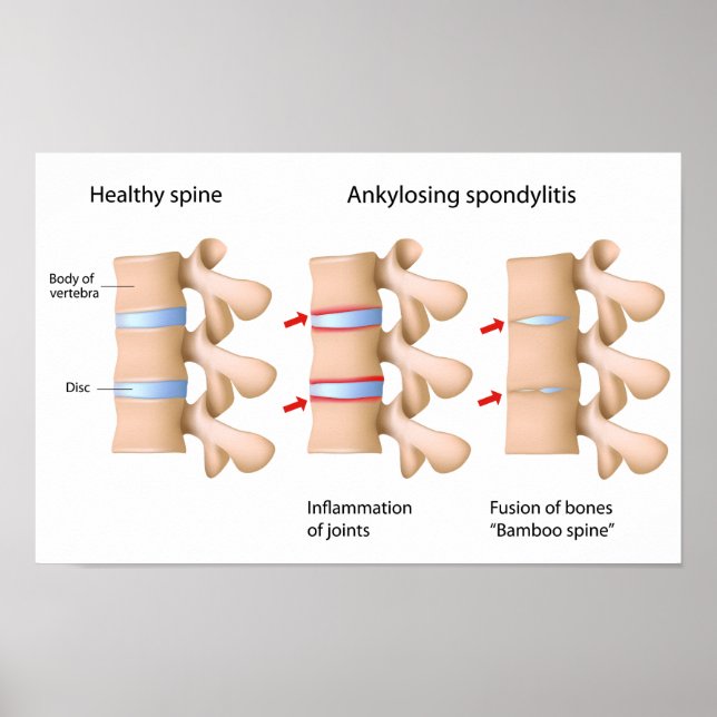 Spine Ankylose spondylitis Poster (Devant)