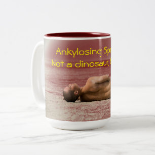 Spondylarthrite ankylosante, pas une tasse de