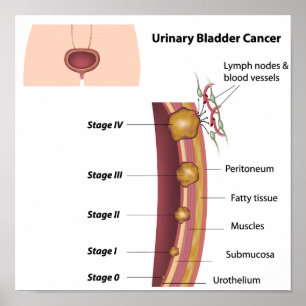 Stages of urinary bladder cancer  Poster