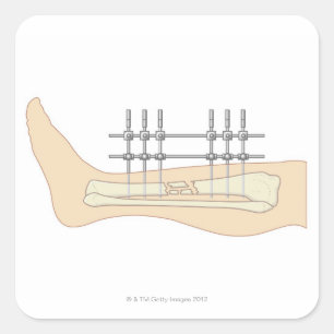 Sticker Carré Fixateur externe