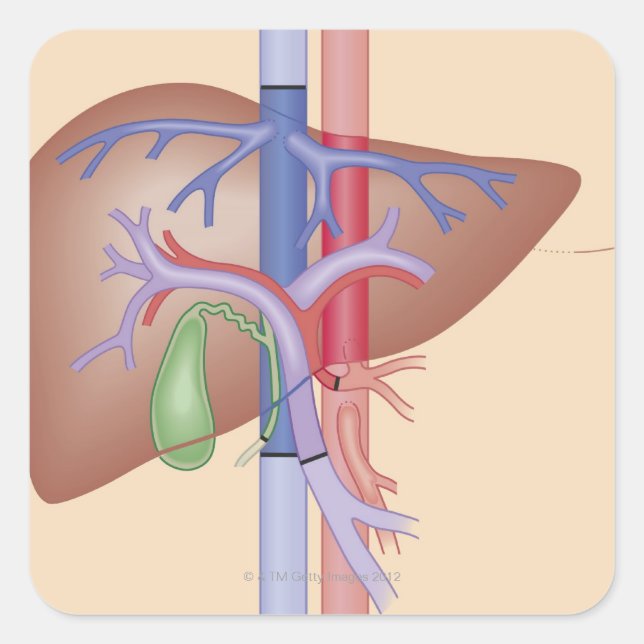 Sticker Carré Procédure de transplantation du foie (Devant)