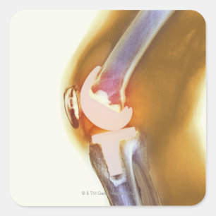 Sticker Carré Remplacement de genou. Rayon X coloré d'un genou