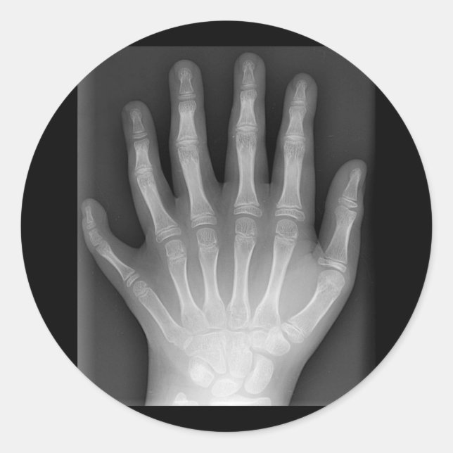 Sticker Rond Polydactylo, Six Doigts, X-Ray, rareté ! (Devant)